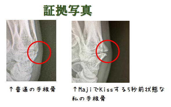 手根骨